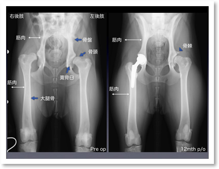 ラブラドール・レトリバー、7ヵ月齢、雌。左右のCHDで右側は左側に比して亜脱臼が重度で筋肉の萎縮が顕著です。THRの1年後、左側の寛骨臼の骨棘は増生し骨関節炎の進行を示していますが、左右の筋肉量は顕著に増加しています。現在、術後6年を良好に経過しています。