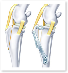 TTA（脛骨粗面前進化術）