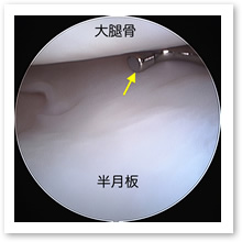 関節鏡像(正常)