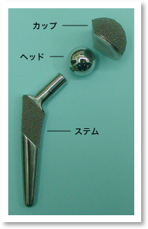 BFXセメントレス人工関節